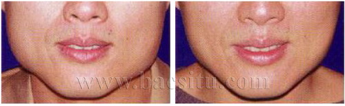 Thon gọn cạnh hàm bằng Botox