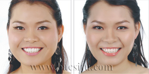 Thon gọn mặt bằng Botox