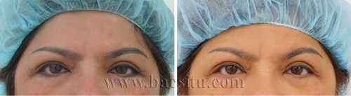 Xóa xăm mí mắt bằng Laser PicoSure