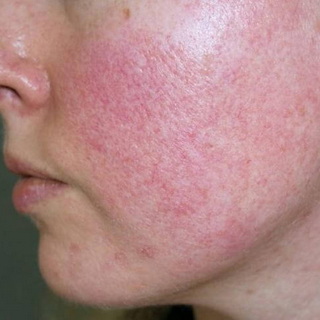Viêm da do mỹ phẩm chứa Corticoid là gì?
