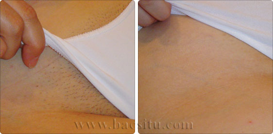 Triệt lông vùng bikini