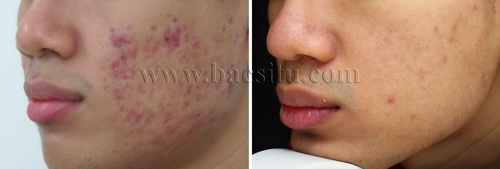 Điều trị mụn bằng Laser